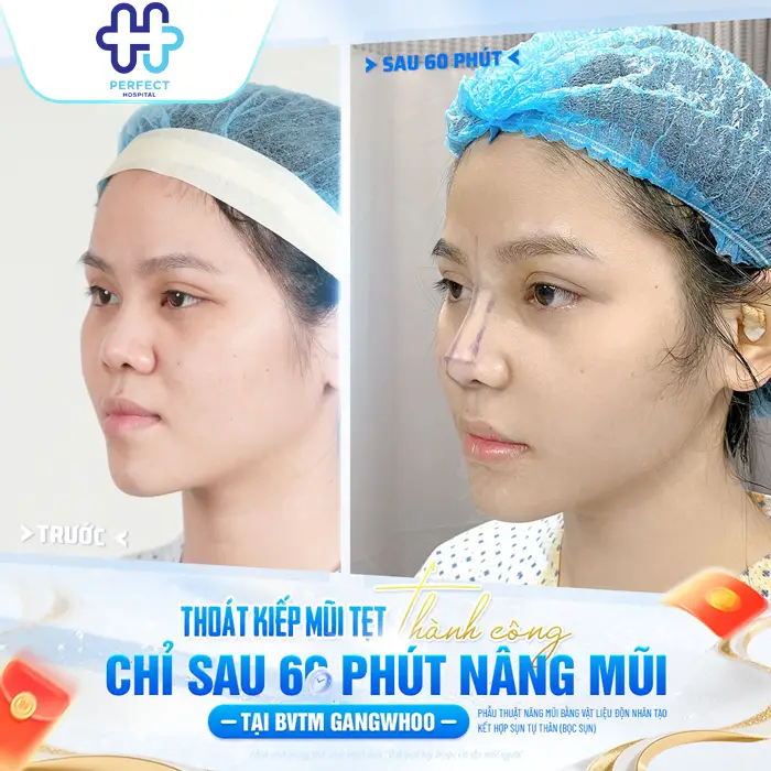 Nâng mũi có ảnh hưởng gì không? Có hại về sau không?
