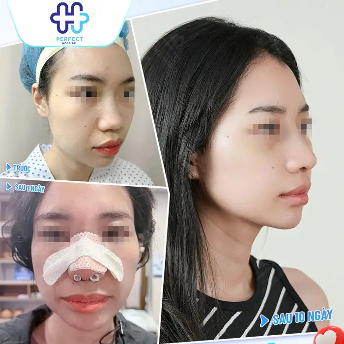 Nâng mũi có ảnh hưởng gì không? Có hại về sau không?