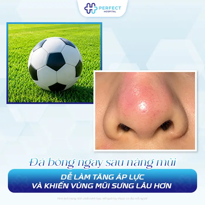 Nâng Mũi Có Đá Bóng Được Không? Bao Lâu Tập Lại An Toàn