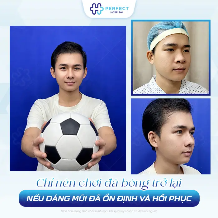 Nâng Mũi Có Đá Bóng Được Không? Bao Lâu Tập Lại An Toàn