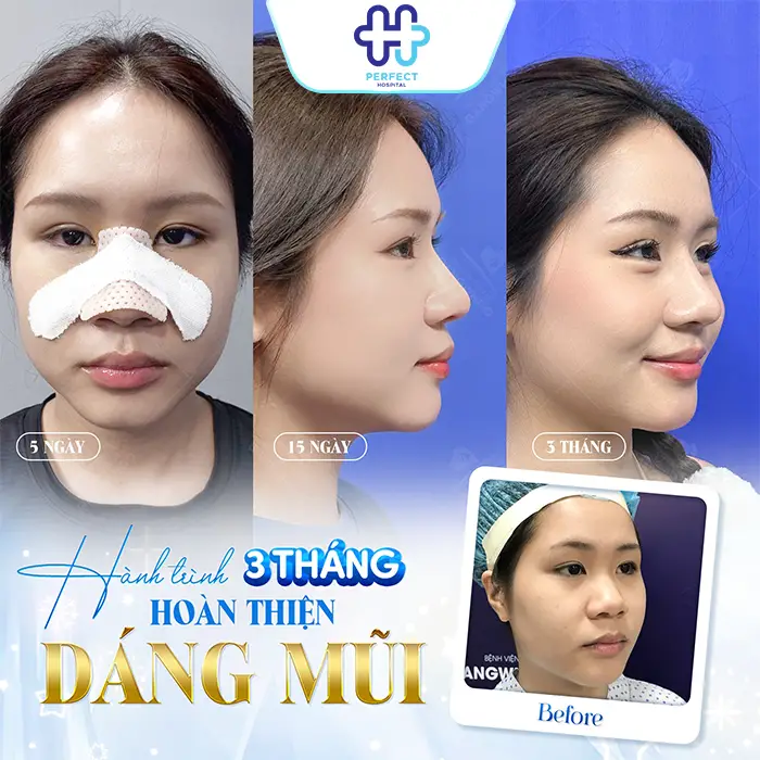 Nâng Mũi Có Để Lại Sẹo Không? Cách Tránh Sẹo Lồi Hiệu Quả