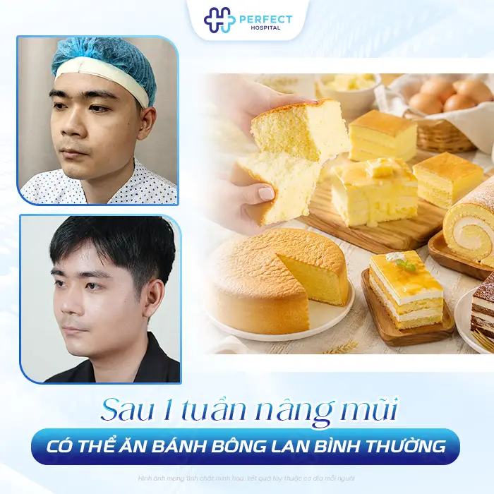 Nâng Mũi Có Được Ăn Bánh Bông Lan Không? Khi Nào Nên Ăn