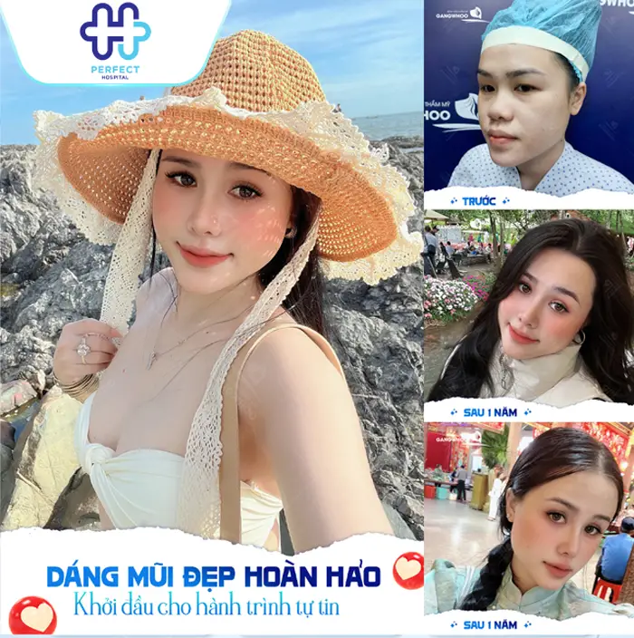 Nâng Mũi Có Nên Cắt Cánh Mũi Không? Khi Nào Cần Kết Hợp?