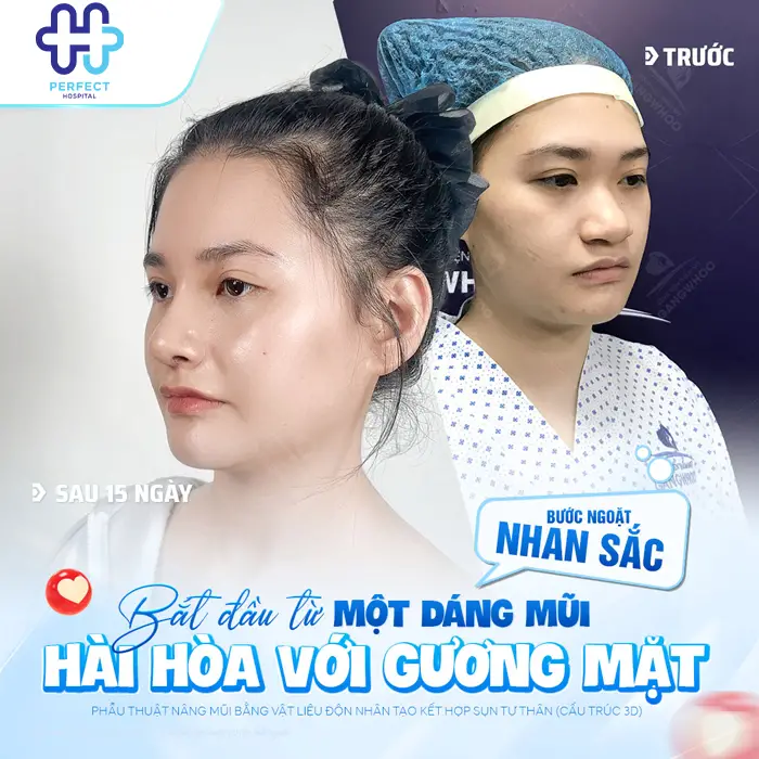 Nâng Mũi Có Nên Cắt Cánh Mũi Không? Khi Nào Cần Kết Hợp?