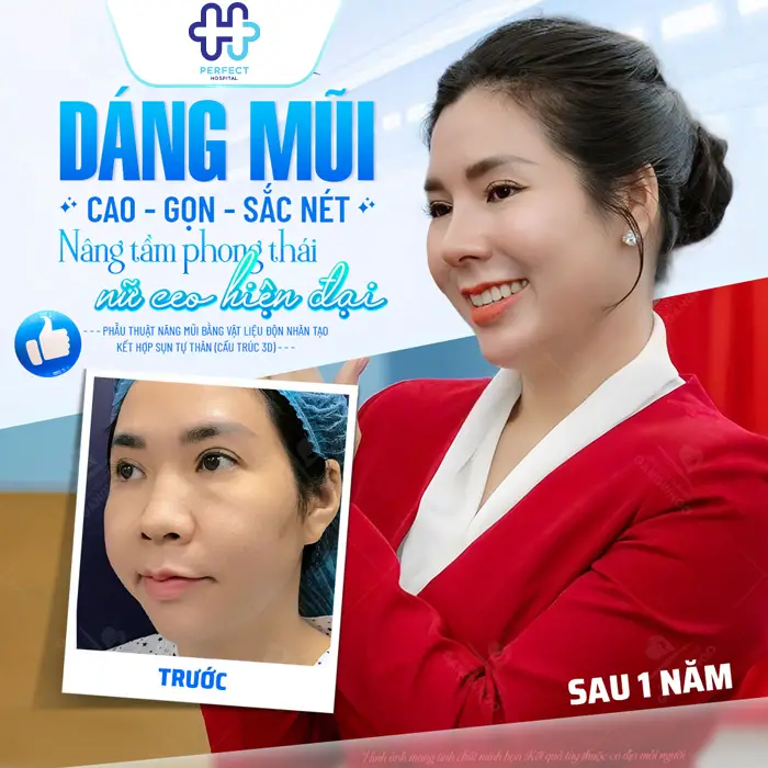 Nâng Mũi Có Nên Cắt Cánh Mũi Không? Khi Nào Cần Kết Hợp?