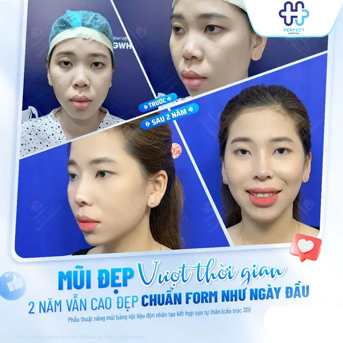 Nâng Mũi Có Nên Cắt Cánh Mũi Không? Khi Nào Cần Kết Hợp?