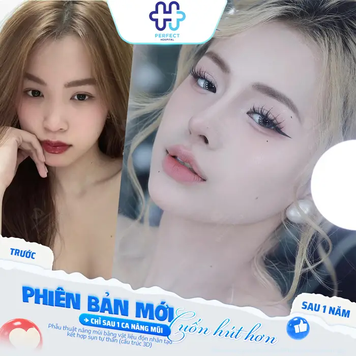 Nâng Mũi Có Nên Cắt Cánh Mũi Không? Khi Nào Cần Kết Hợp?