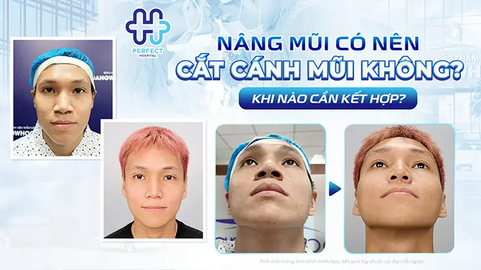 Nâng Mũi Có Nên Cắt Cánh Mũi Không? Khi Nào Cần Kết Hợp?
