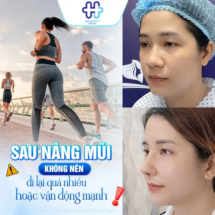 Nâng Mũi Có Nên Đi Lại Nhiều Không? Hướng Dẫn Vận Động Đúng Cách Sau Phẫu Thuật