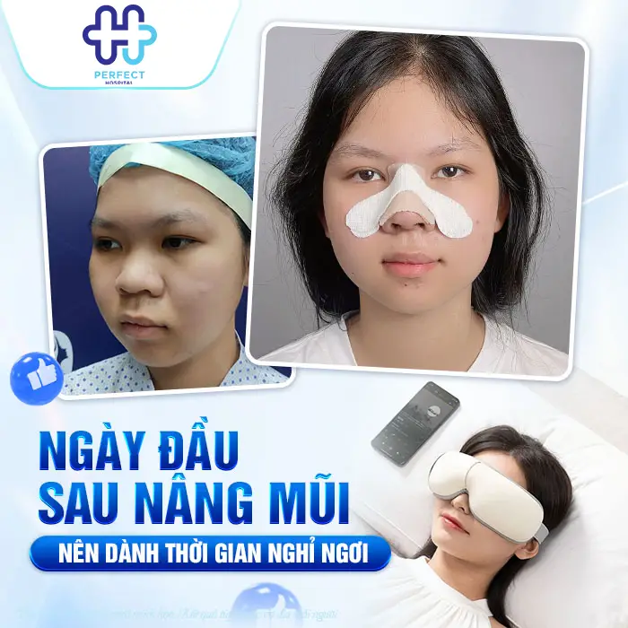 Nâng Mũi Có Nên Đi Lại Nhiều Không? Hướng Dẫn Vận Động Đúng Cách Sau Phẫu Thuật
