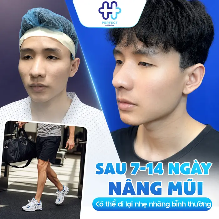 Nâng Mũi Có Nên Đi Lại Nhiều Không? Hướng Dẫn Vận Động Đúng Cách Sau Phẫu Thuật