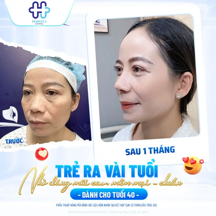 Nâng Mũi Có Thay Đổi Khuôn Mặt Không? Phân Tích Chi Tiết Từ Góc Nhìn Thẩm Mỹ