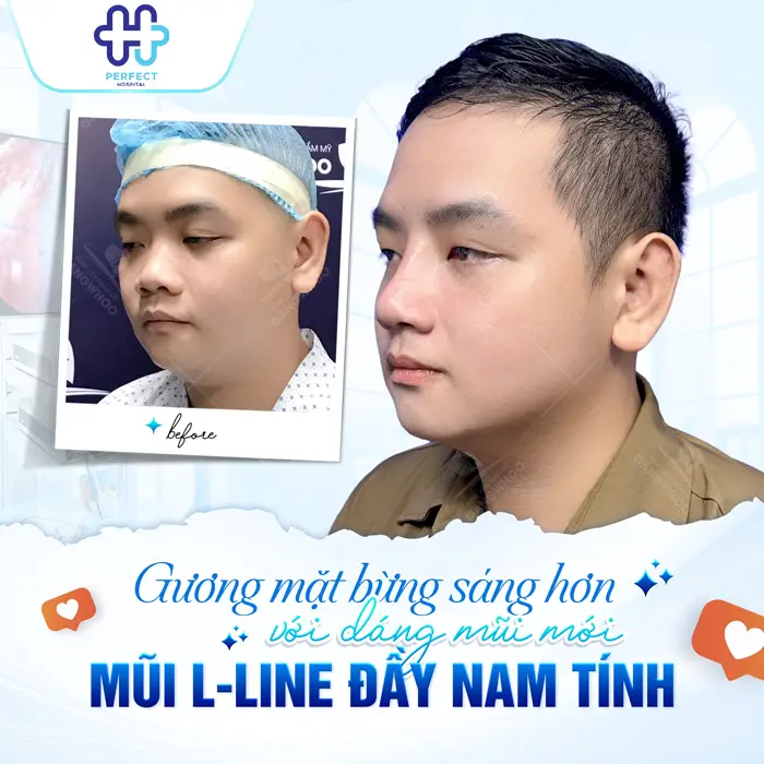 Nâng Mũi Có Thay Đổi Khuôn Mặt Không? Phân Tích Chi Tiết Từ Góc Nhìn Thẩm Mỹ