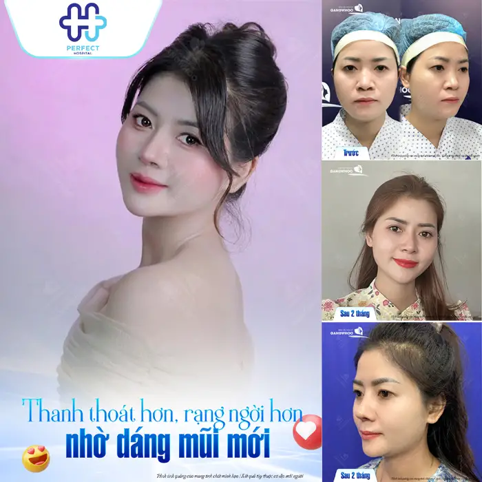 Nâng Mũi Có Thay Đổi Khuôn Mặt Không? Phân Tích Chi Tiết Từ Góc Nhìn Thẩm Mỹ