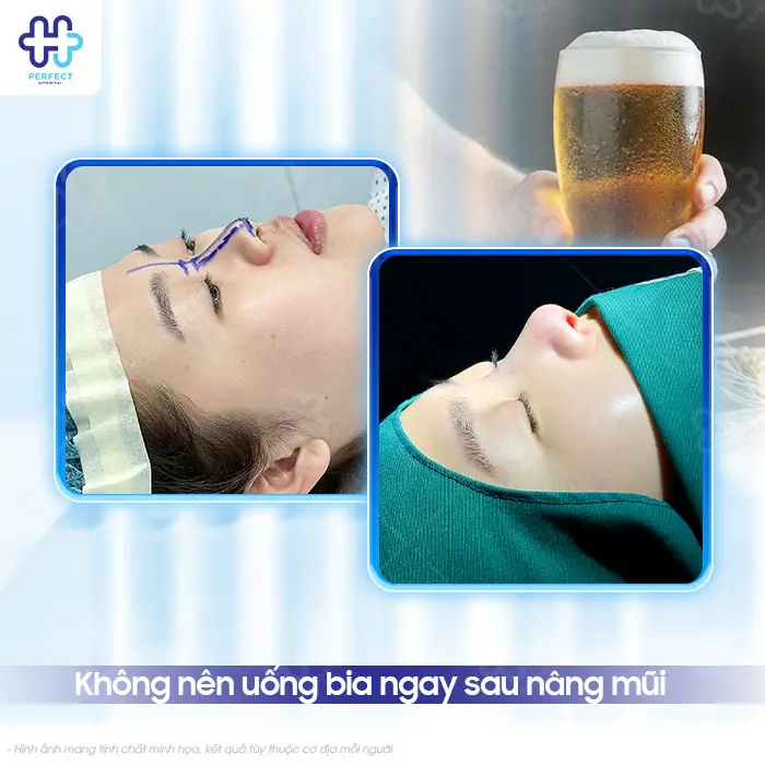 Nâng Mũi Có Được Uống Bia Không? Thời Điểm An Toàn Cần Biết