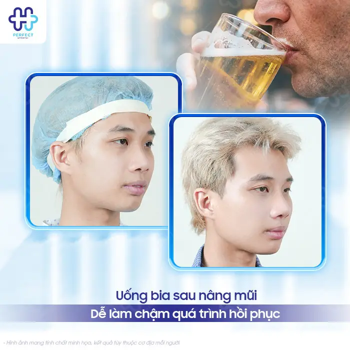 Nâng Mũi Có Được Uống Bia Không? Thời Điểm An Toàn Cần Biết