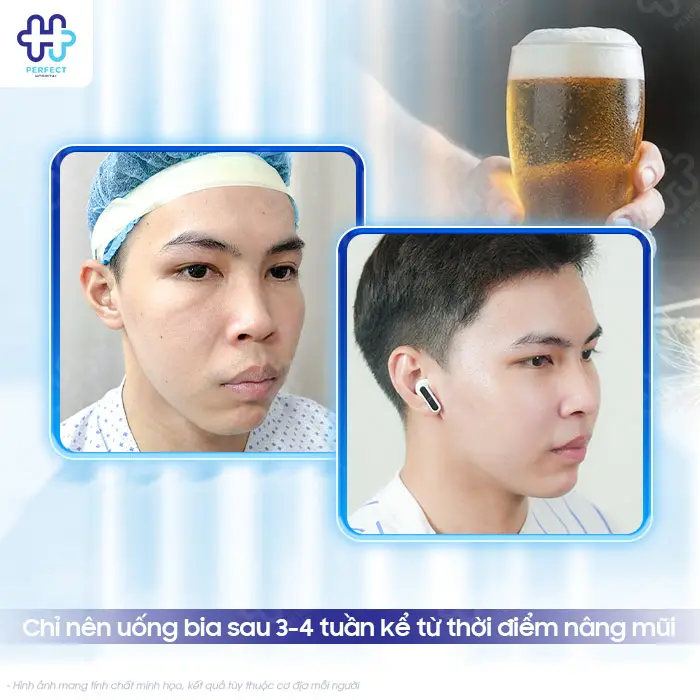 Nâng Mũi Có Được Uống Bia Không? Thời Điểm An Toàn Cần Biết