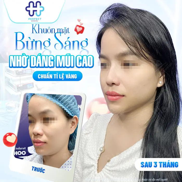 Nâng Mũi Có Vĩnh Viễn Không? Bao Lâu Thì Cần Làm Lại