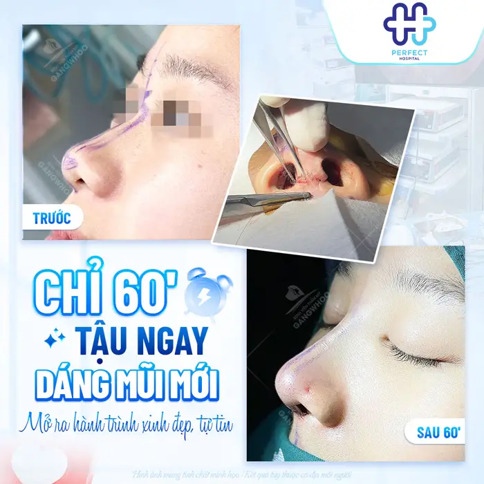 Nâng Mũi Có Vĩnh Viễn Không? Bao Lâu Thì Cần Làm Lại