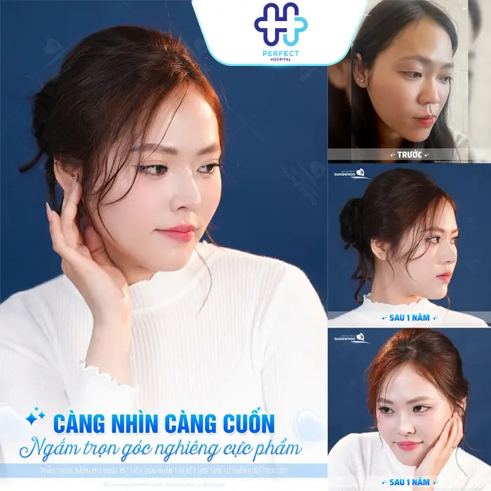 Nâng Mũi Có Vĩnh Viễn Không? Bao Lâu Thì Cần Làm Lại