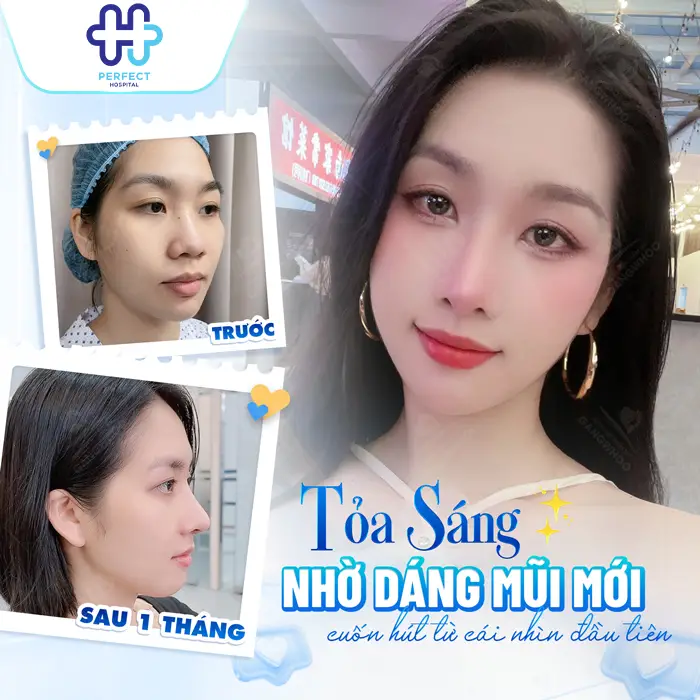 Nâng Mũi Có Vĩnh Viễn Không? Bao Lâu Thì Cần Làm Lại