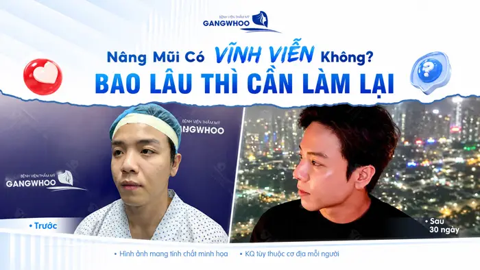 Nâng Mũi Có Vĩnh Viễn Không? Bao Lâu Thì Cần Làm Lại