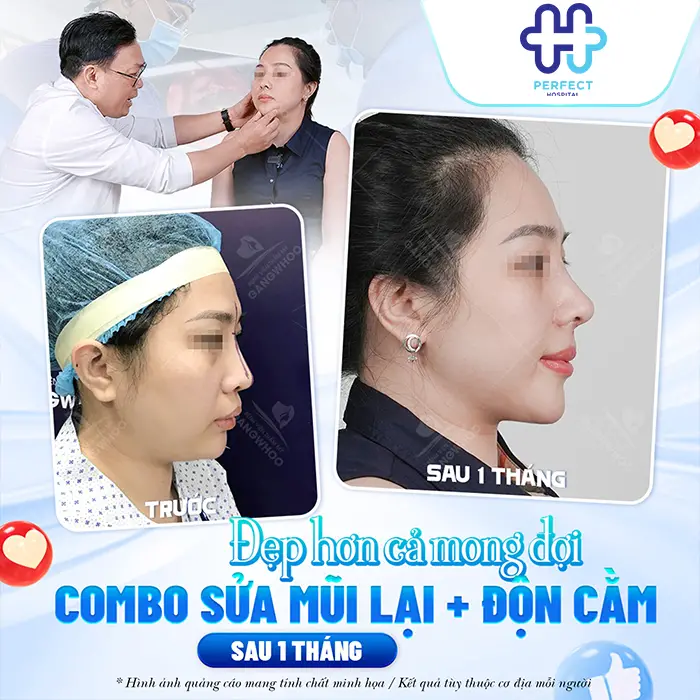 Nâng Mũi Độn Cằm Có Nên Làm Chung Không? Bí Quyết Tạo Gương Mặt Chuẩn