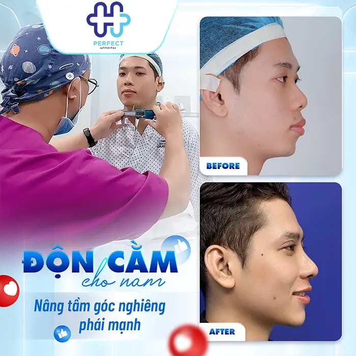 Nâng Mũi Độn Cằm Có Nên Làm Chung Không? Bí Quyết Tạo Gương Mặt Chuẩn