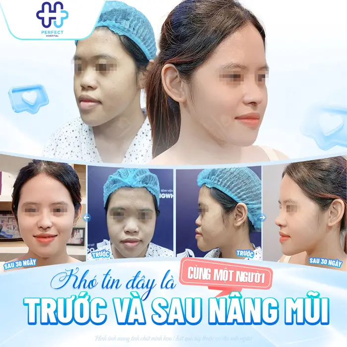 Nâng Mũi Được 1 Tháng Đã Đẹp Và Ổn Định Chưa? Dấu Hiệu Hồi Phục Chuẩn