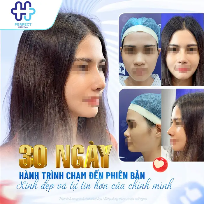 Nâng Mũi Được 1 Tháng Đã Đẹp Và Ổn Định Chưa? Dấu Hiệu Hồi Phục Chuẩn