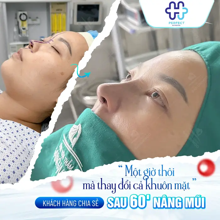 Nâng Mũi Gây Tê Hay Mê Lựa Chọn Nào An Toàn Và Phù Hợp