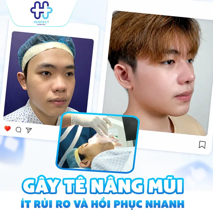 Nâng Mũi Gây Tê Hay Mê Lựa Chọn Nào An Toàn Và Phù Hợp