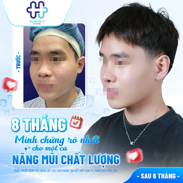 Nâng Mũi Hàn Quốc Được Bao Lâu? Độ Bền Và Cách Giữ Dáng Mũi Đẹp Lâu Dài