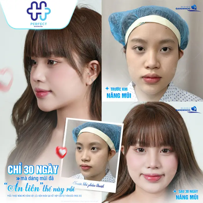 Nâng Mũi Hàn Quốc Được Bao Lâu? Độ Bền Và Cách Giữ Dáng Mũi Đẹp Lâu Dài