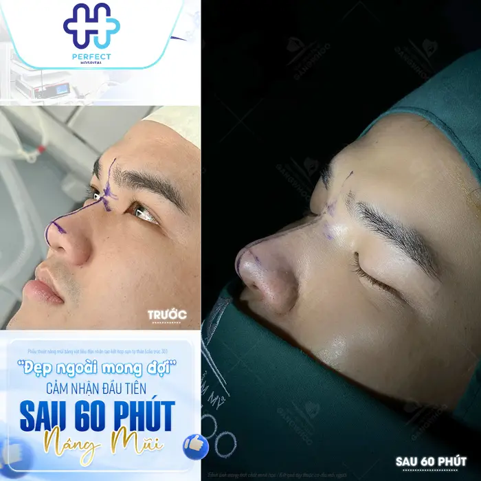 Nâng Mũi Hàn Quốc Được Bao Lâu? Độ Bền Và Cách Giữ Dáng Mũi Đẹp Lâu Dài