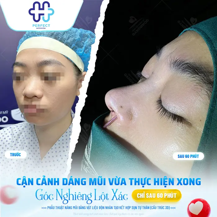 Nâng Mũi Hàn Quốc Được Bao Lâu? Độ Bền Và Cách Giữ Dáng Mũi Đẹp Lâu Dài