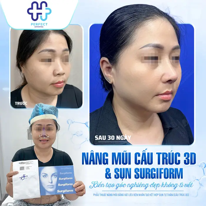 Nâng Mũi Hàn Quốc Được Bao Lâu? Độ Bền Và Cách Giữ Dáng Mũi Đẹp Lâu Dài