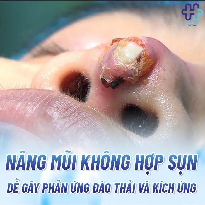 Nâng Mũi Không Hợp Sụn Là Gì Và Dấu Hiệu Nhận Biết Sớm