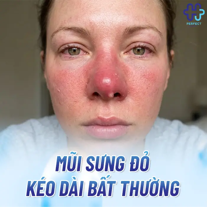 Nâng Mũi Không Hợp Sụn Là Gì Và Dấu Hiệu Nhận Biết Sớm