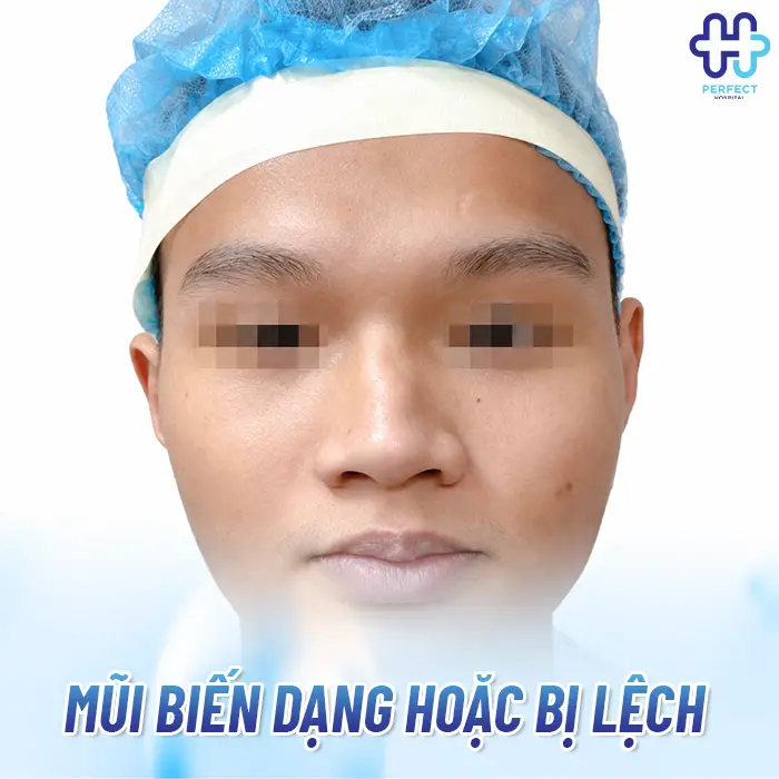 Nâng Mũi Không Hợp Sụn Là Gì Và Dấu Hiệu Nhận Biết Sớm