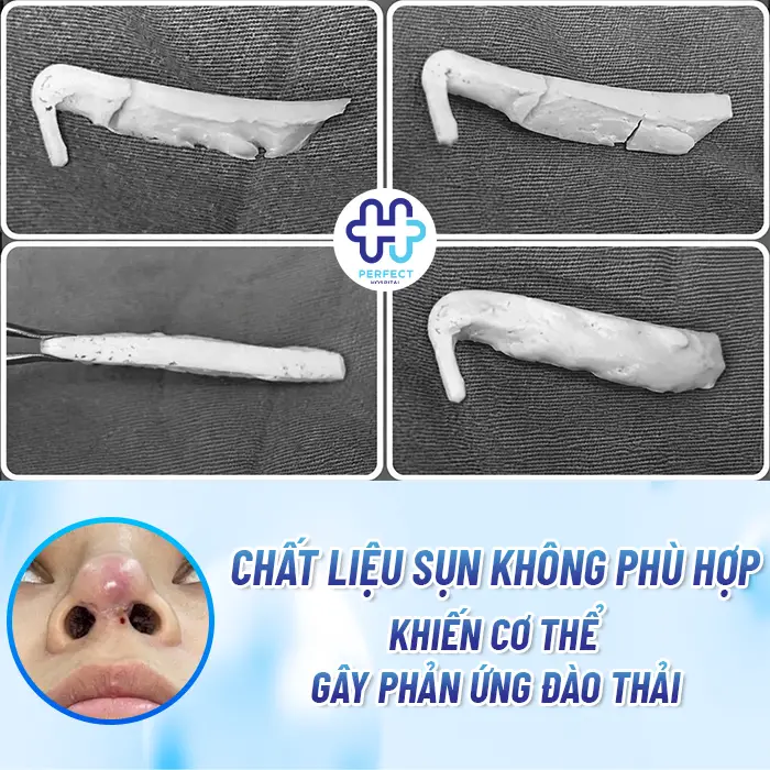 Nâng Mũi Không Hợp Sụn Là Gì Và Dấu Hiệu Nhận Biết Sớm