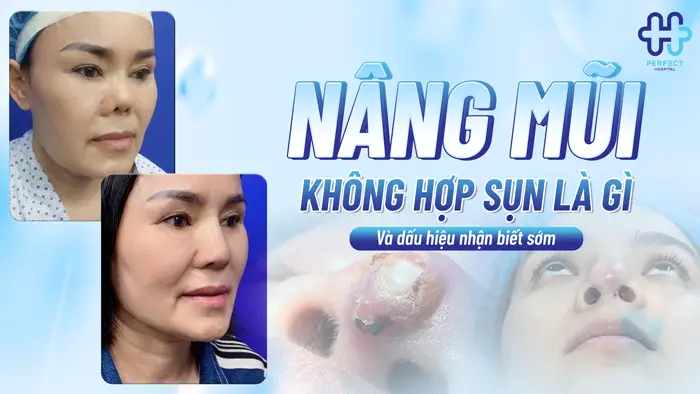 Nâng Mũi Không Hợp Sụn Là Gì Và Dấu Hiệu Nhận Biết Sớm