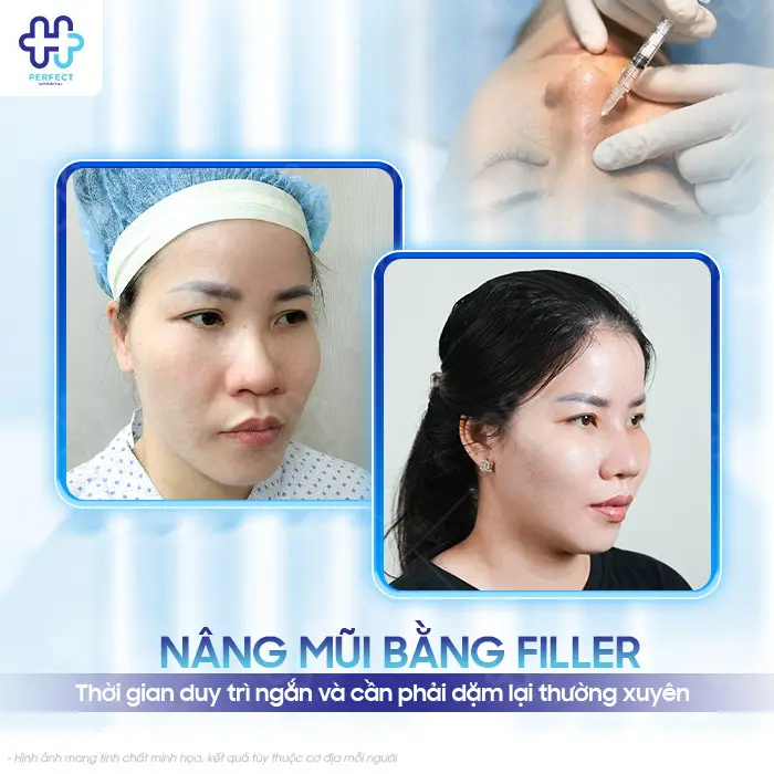 Nâng Mũi Không Phẫu Thuật Được Bao Lâu? Có Lâu Dài Không?