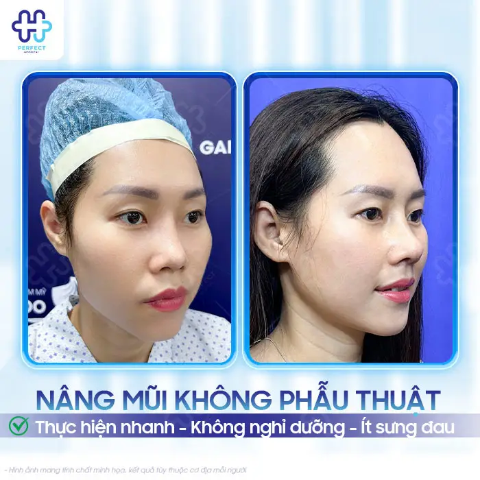 Nâng Mũi Không Phẫu Thuật Được Bao Lâu? Có Lâu Dài Không?