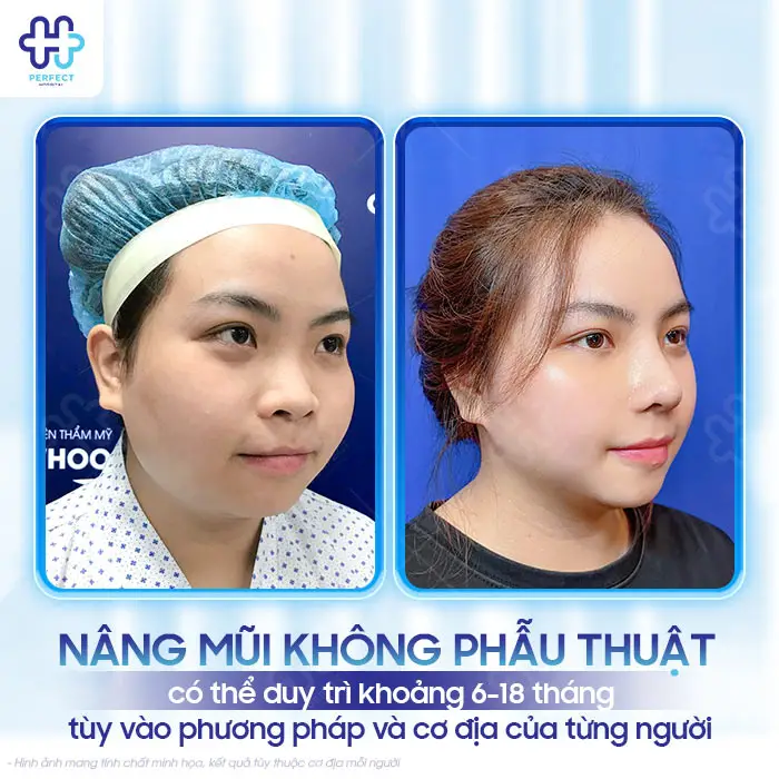 Nâng Mũi Không Phẫu Thuật Được Bao Lâu? Có Lâu Dài Không?