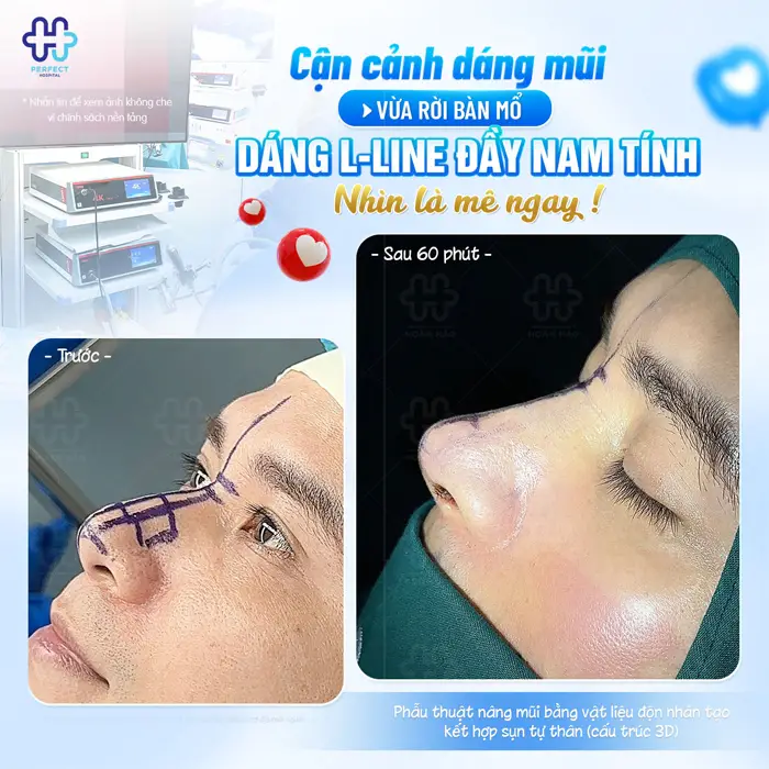 Nâng Mũi L Line Cho Nam: Dáng Mũi Chuẩn Nam Tính Và Những Điều Cần Biết
