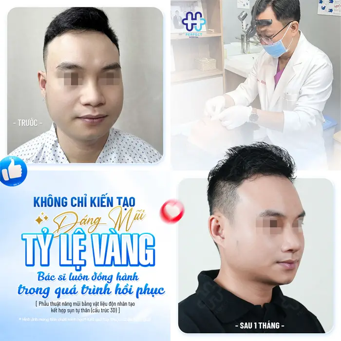 Nâng Mũi L Line Cho Nam: Dáng Mũi Chuẩn Nam Tính Và Những Điều Cần Biết