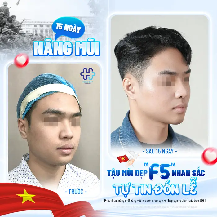 Nâng Mũi L Line Cho Nam: Dáng Mũi Chuẩn Nam Tính Và Những Điều Cần Biết