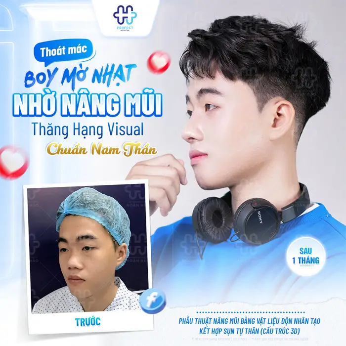 Nâng Mũi L Line Cho Nam: Dáng Mũi Chuẩn Nam Tính Và Những Điều Cần Biết