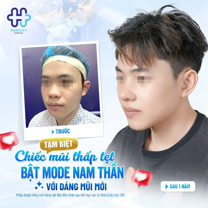 Nâng Mũi L Line Cho Nam: Dáng Mũi Chuẩn Nam Tính Và Những Điều Cần Biết